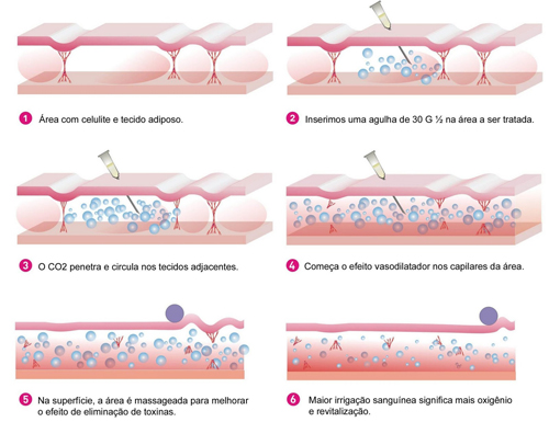 Carboxiterapia na Privé MEDSPA